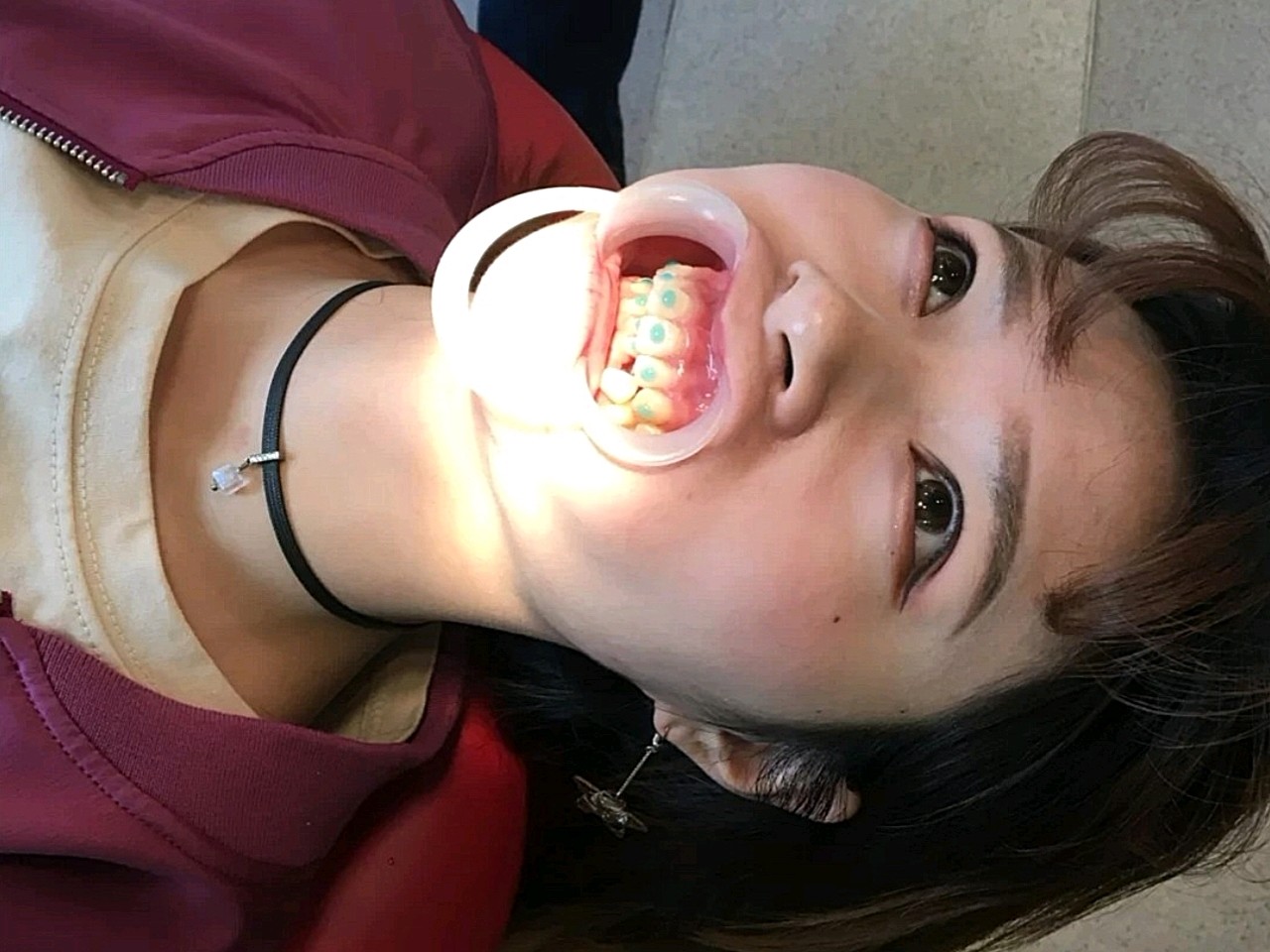 牙齿矫正陶瓷自锁牙套比传统的铁牙套要美观一些,_圈子-新氧美容