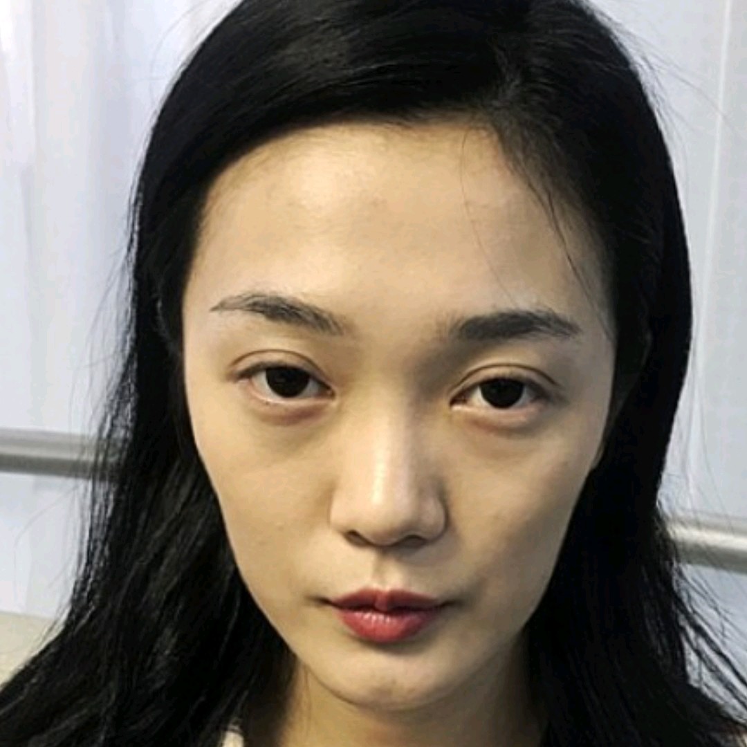 自体脂肪填充全脸分享~不惜贡献出自己的素颜丑照