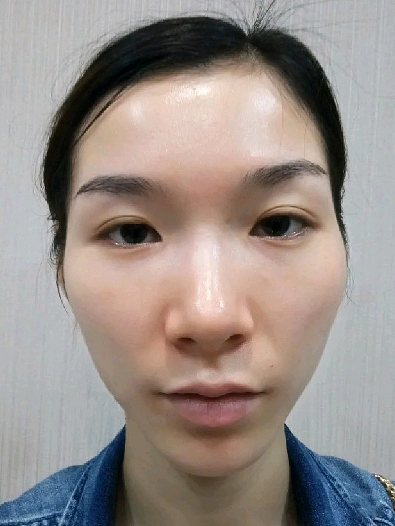 终于来做了心心念念的自体脂肪全脸填充,其实大家从我_圈子-新氧美容