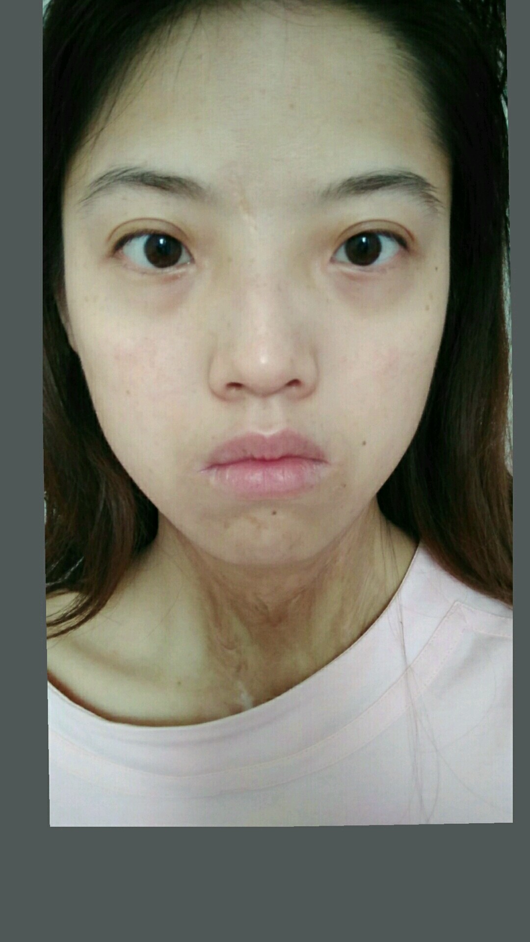 下颌角发大正面照看不出来.