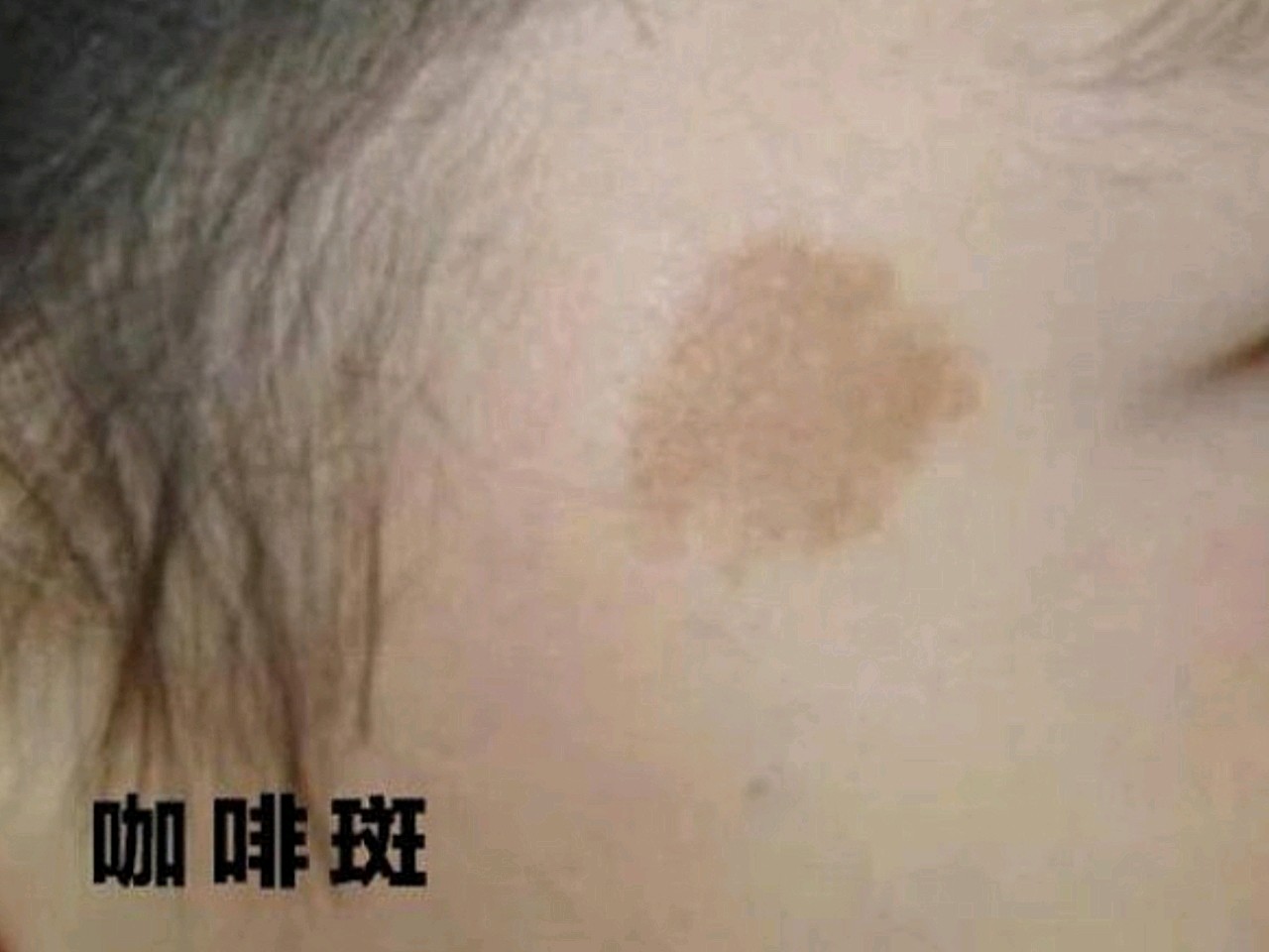 74黄褐斑边界不清晰,成片状对称分_圈子-新氧美容整形