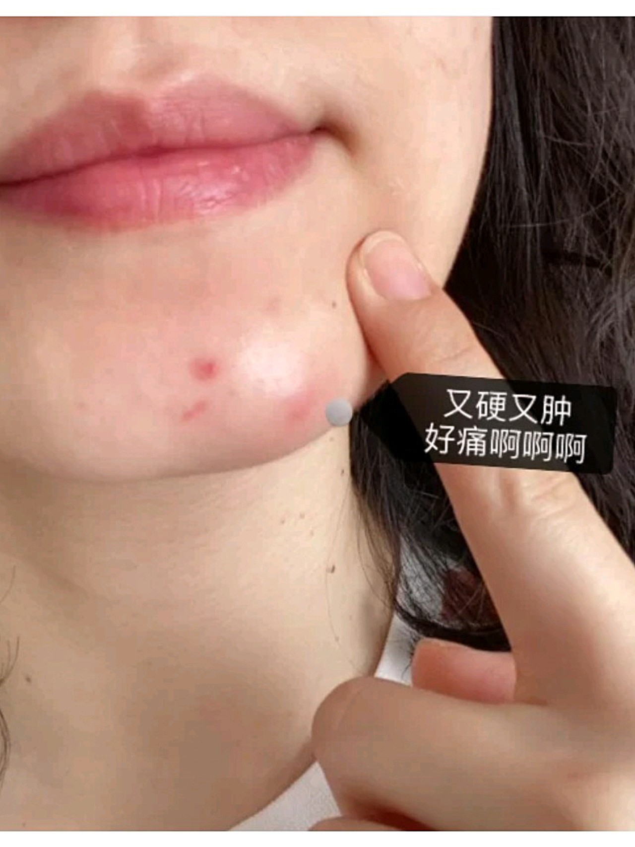 这是一篇求助的笔记,关于又硬又肿的痘痘