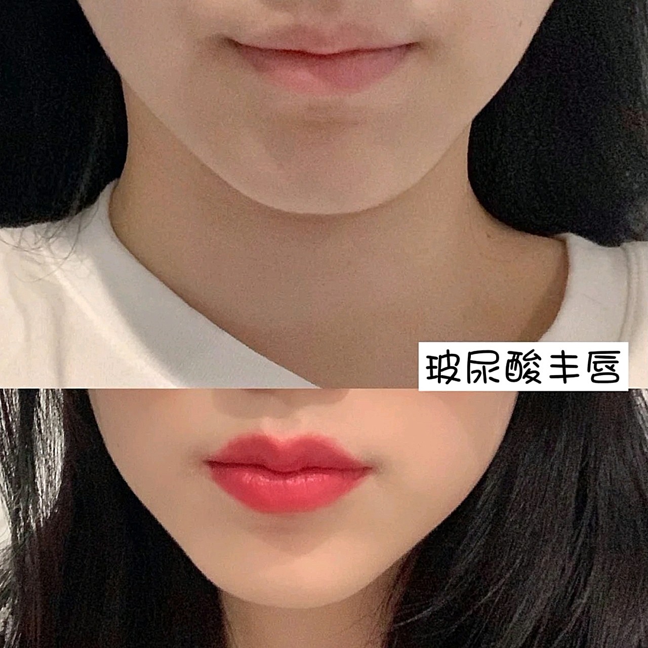 7915伊婉一直是自己比较信赖的玻尿酸牌子,伊婉c小分_圈子-新氧