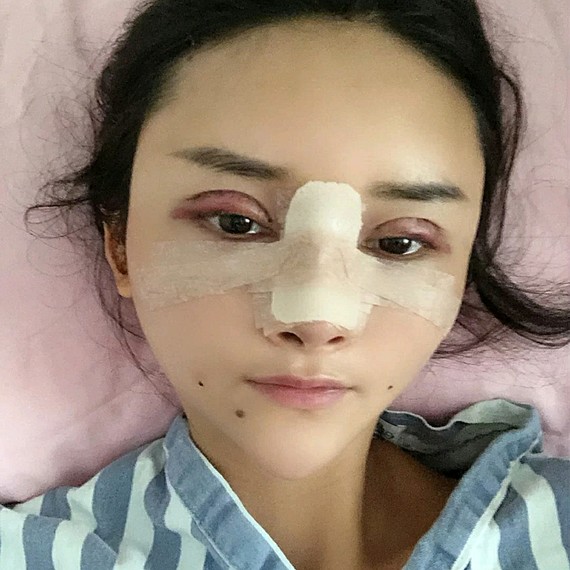 第一次做整容手术