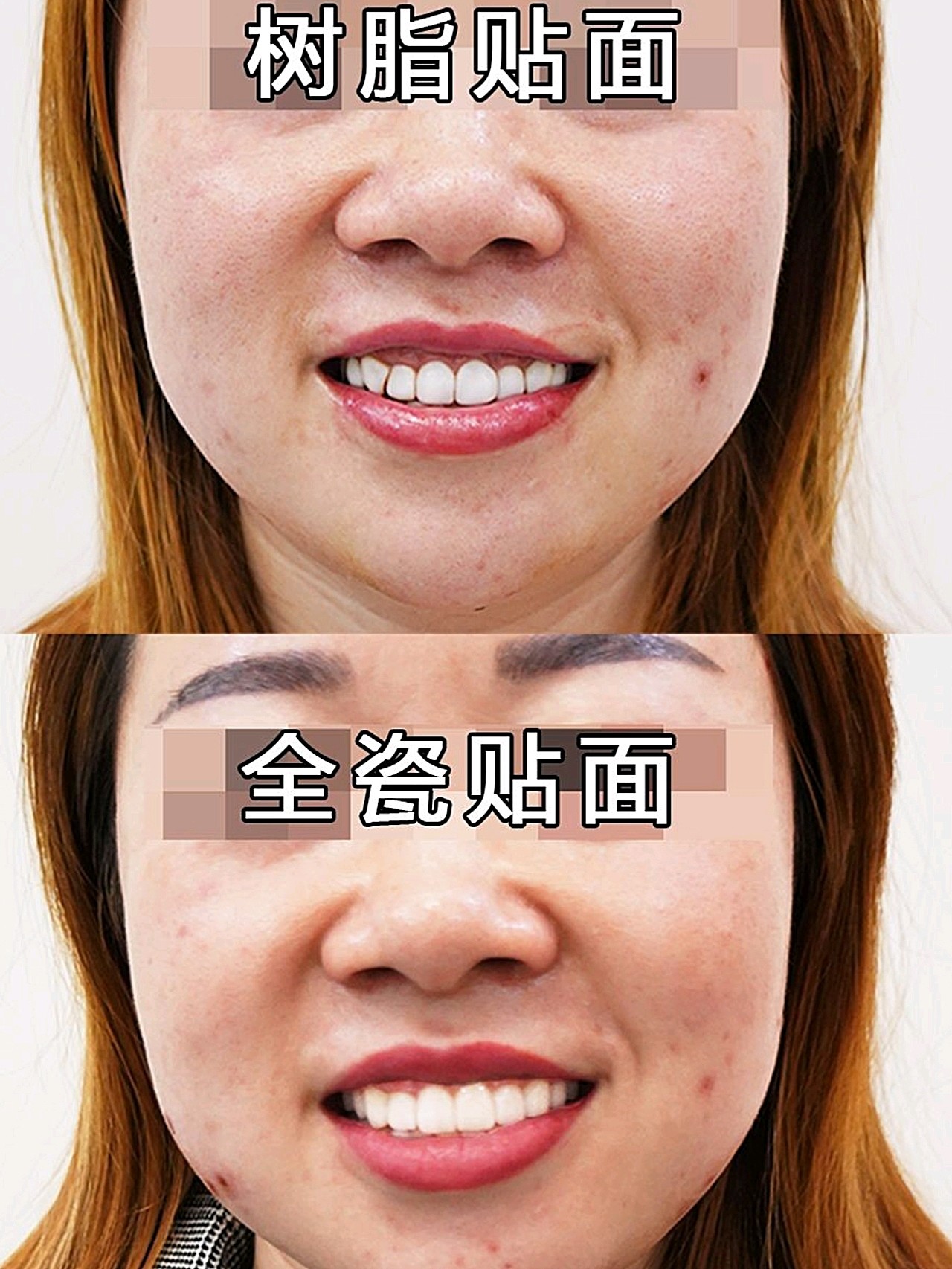 便宜不等于实惠,树脂贴面vs瓷贴面该怎么选?