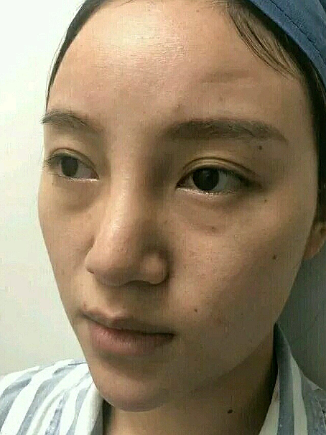 之前鼻子做的假体歪了,鼻根增生,现在取出来重新修