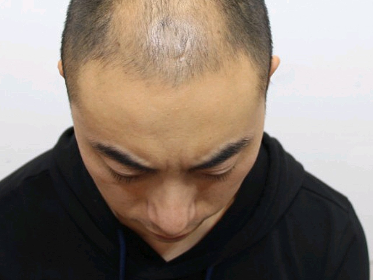 1天可能是遗传,以前二十多岁的时候就有点头发稀疏,_圈子-新氧美容