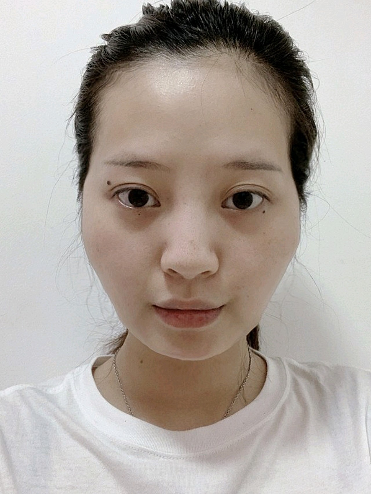 我的面部真的是非常凹陷了.