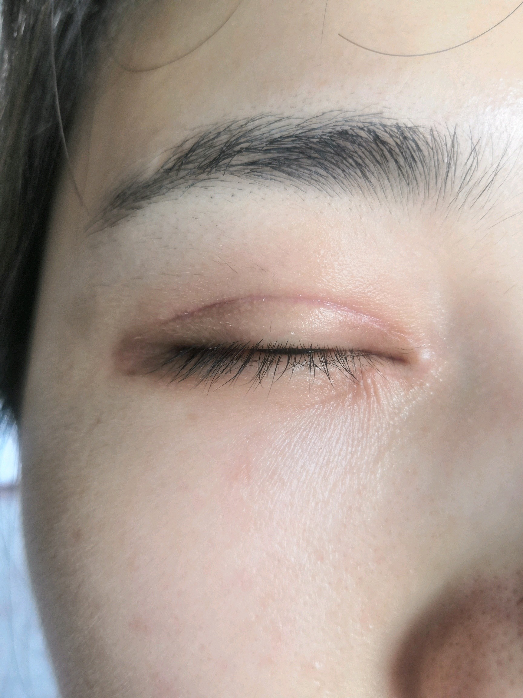 割完双眼皮第79天,左眼角的疤痕自然明显,右眼角有