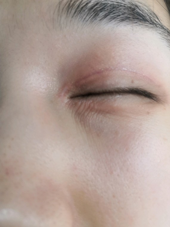 割完双眼皮第79天,左眼角的疤痕自然明显,右眼角有_圈子-新氧美容整形