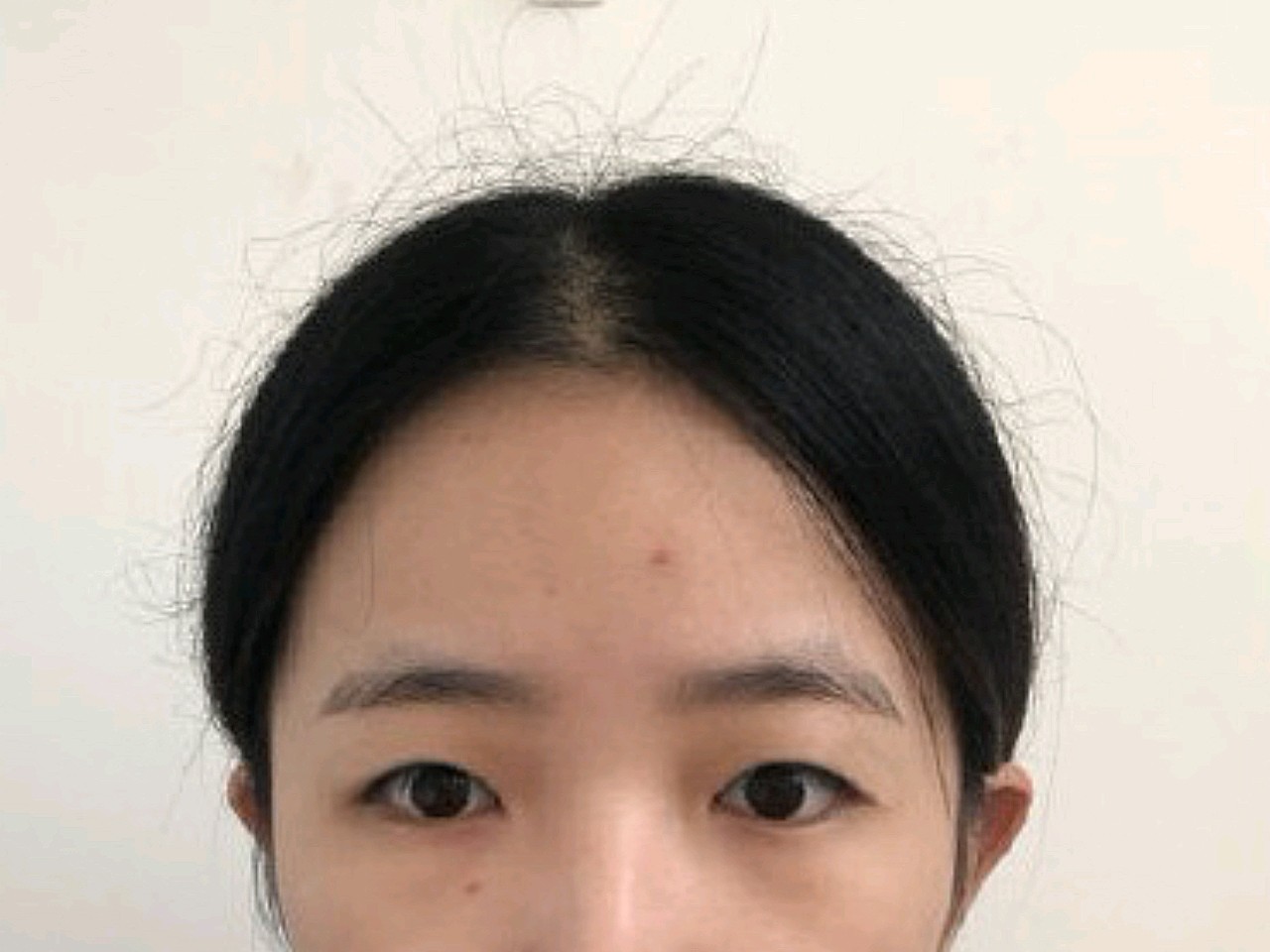 内双,眼部脂肪还比较厚,显得眼睛无神又呆滞,着实让_圈子-新氧美容