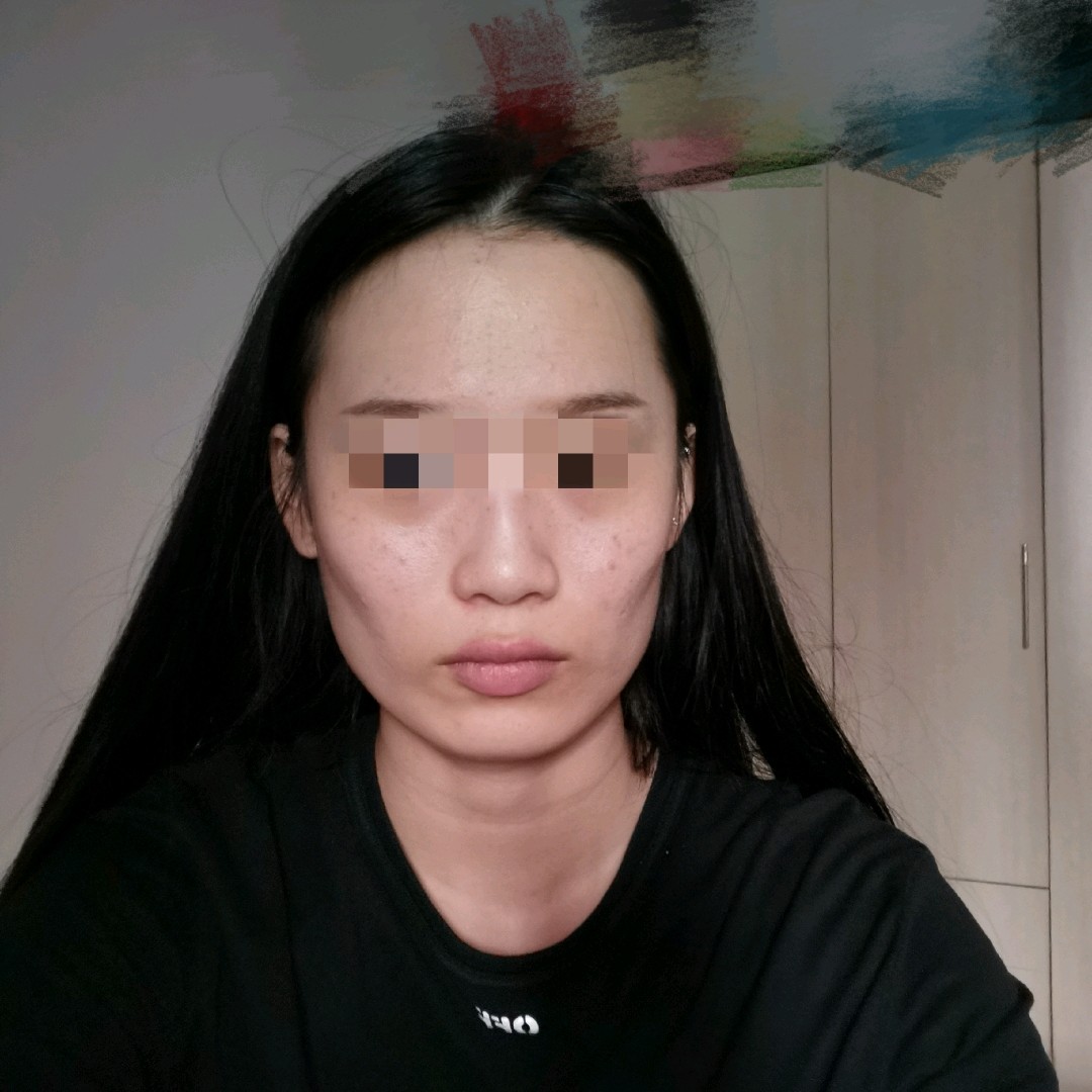 像我这样脸型属于什么脸型这有些凹陷的话我是应该填充脸颊还是去磨骨