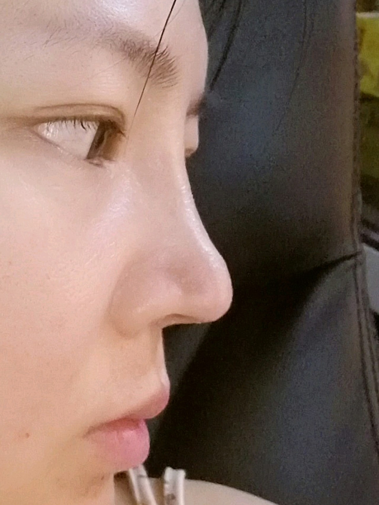 鼻部多项半个月了,鼻孔一大一小,鼻头一多一少,每天晚_圈子-新氧美容