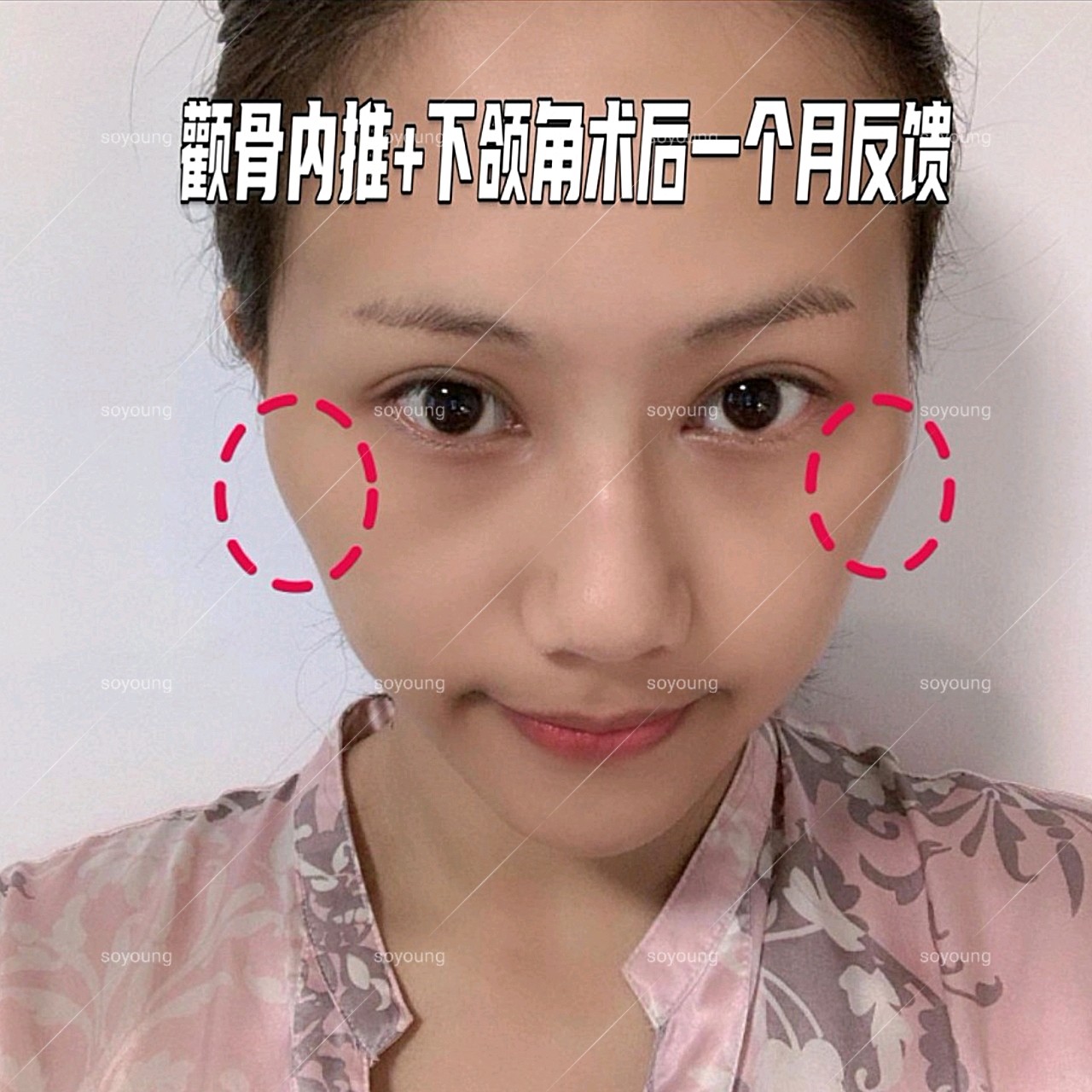 颧骨内推下颌角截骨一个月反馈分享