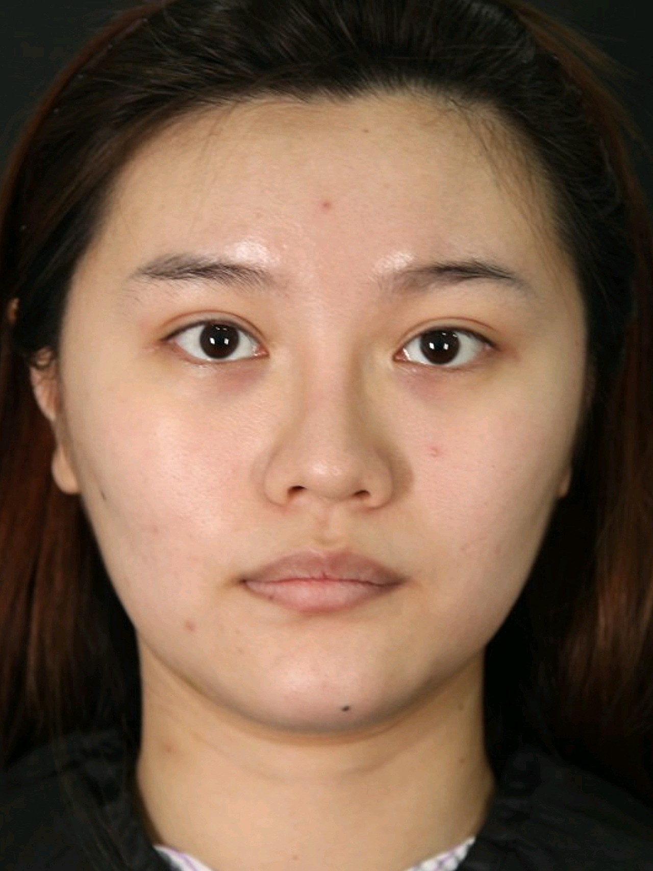 薛志强鼻基底3个月,换了一张脸?💅个人感受:我本身_圈子-新氧美容整