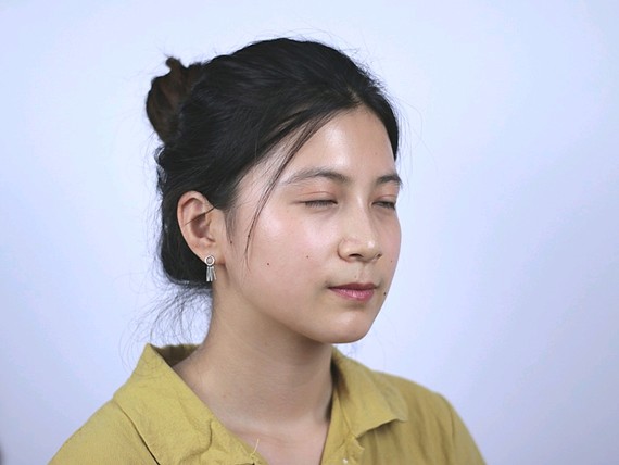 【神线医疗美容切开双眼皮术后90天】