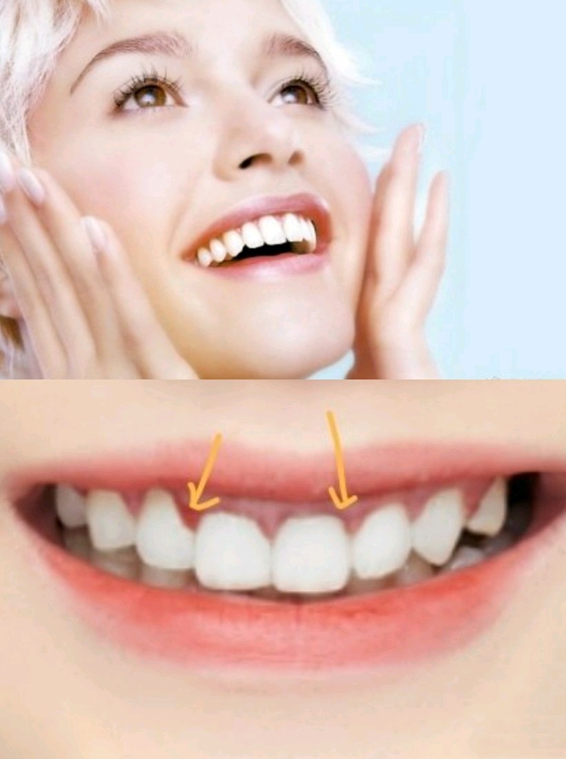 吴昕在一档节目99的游戏环节中自爆自己的牙是假牙.