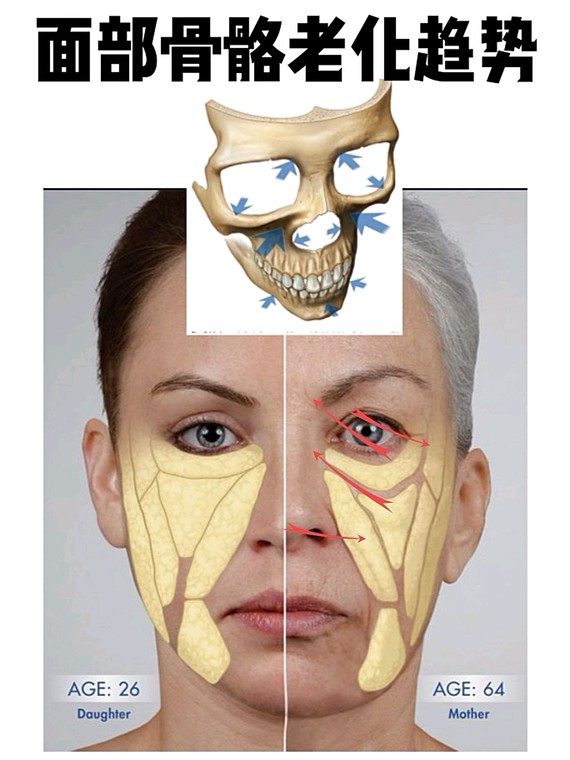 你的眼袋淚溝可能是因為骨骼衰老0575