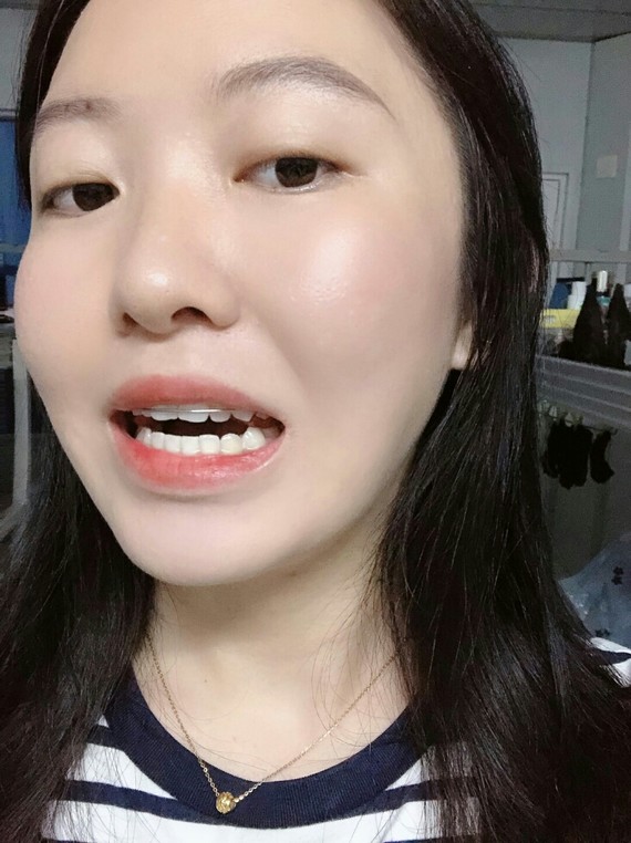 我现在是处于扩弓的阶段,因为上牙弓有些窄,需要戴