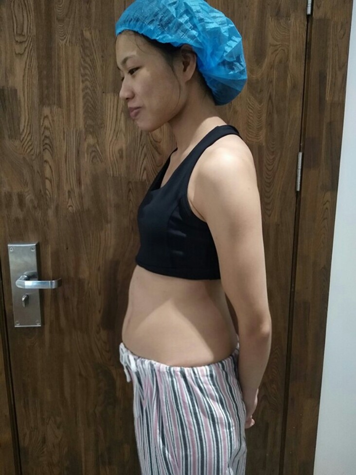 我一个朋友也做了腰腹的,现在身材很漂亮,所以我特羡慕.