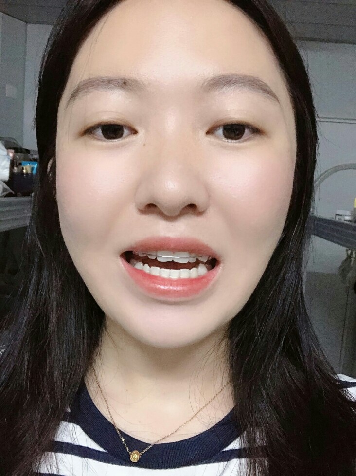 我现在是处于扩弓的阶段,因为上牙弓有些窄,需要戴扩_圈子-新氧美容
