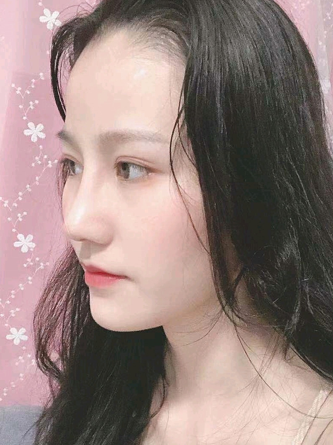 半肋软骨隆鼻祩54天