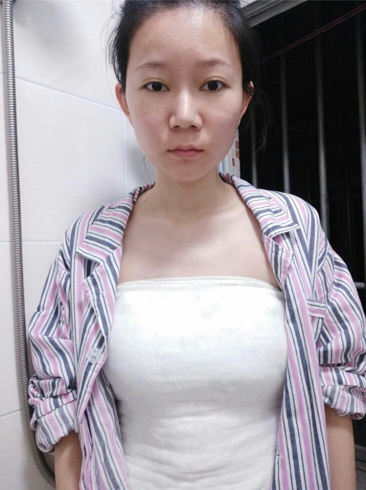 【假体隆胸第4天】