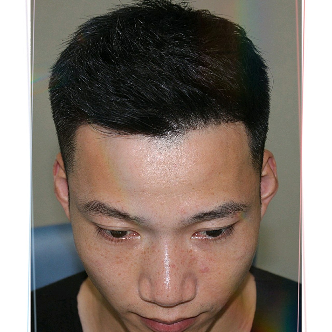 我两个额角部位后退的情况实在有点严重了,以前也咨询_圈子-新氧美容