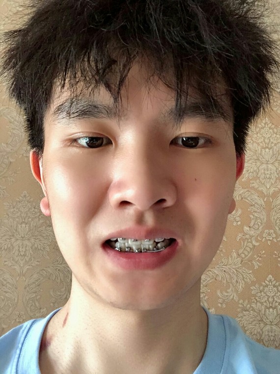 金属自锁矫正术后第60天戴牙套的第二个月,前几天刚_圈子-新氧美容