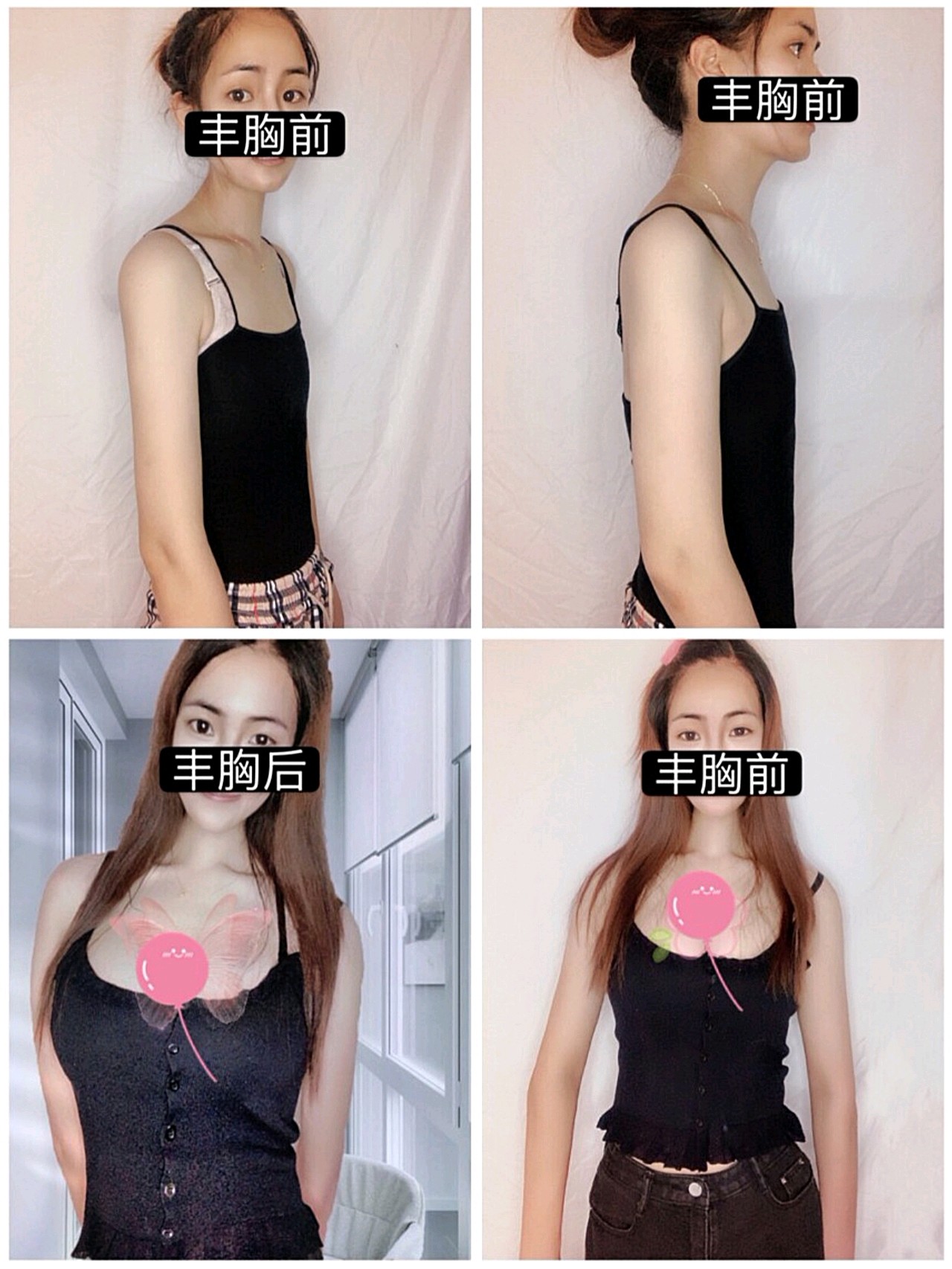 【自体脂肪形体雕塑】隆胸 ,【自体脂肪形体雕塑】隆