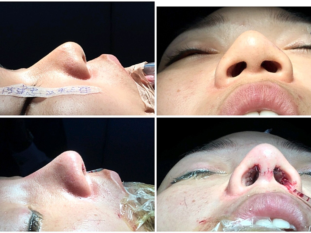 单纯假体(l型)隆鼻术后鼻小柱歪斜,行肋软骨修复._圈子-新氧美容整形