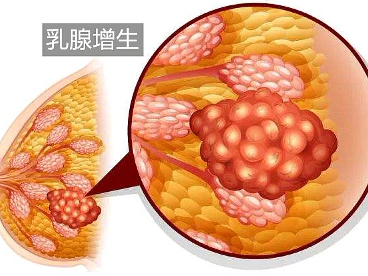 乳腺增生照片图片