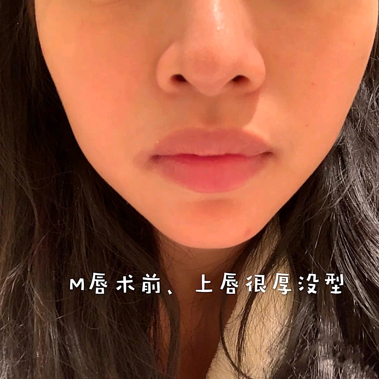 有点粗糙,还有点嘴凸,虽然别人都_圈子-新氧美容整形