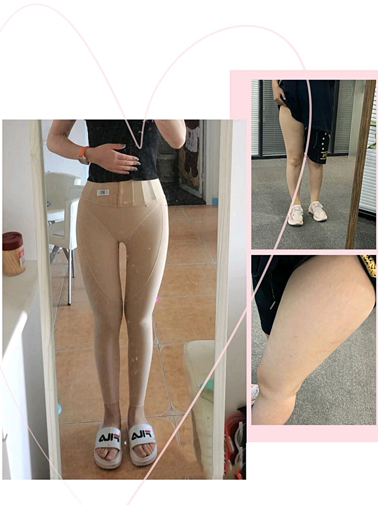 【沈阳汇美人大腿吸脂术后第9天】