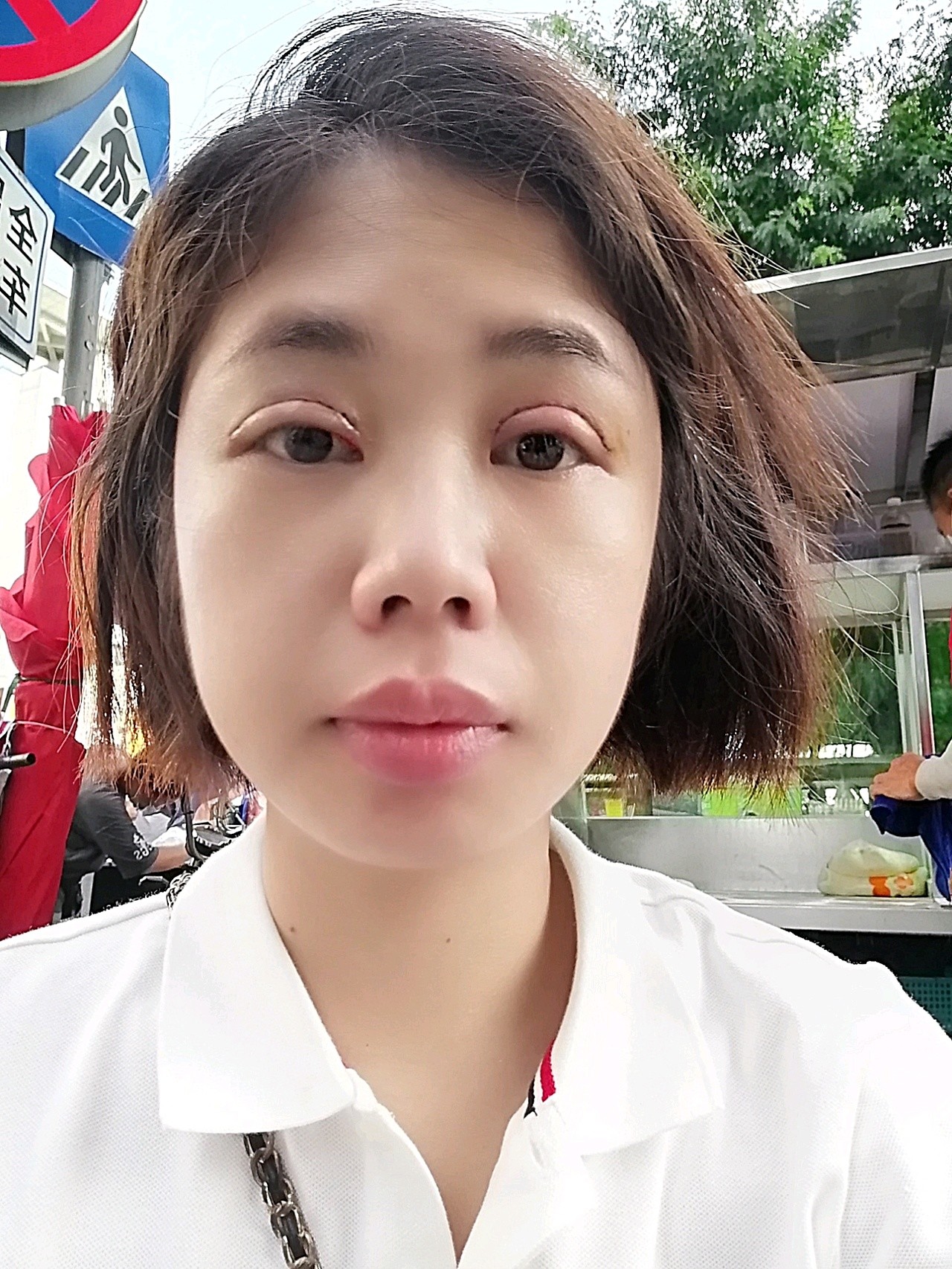 左眼先天性眼睑下垂,现在做完手术后发现很还是大小不对称,这个问题