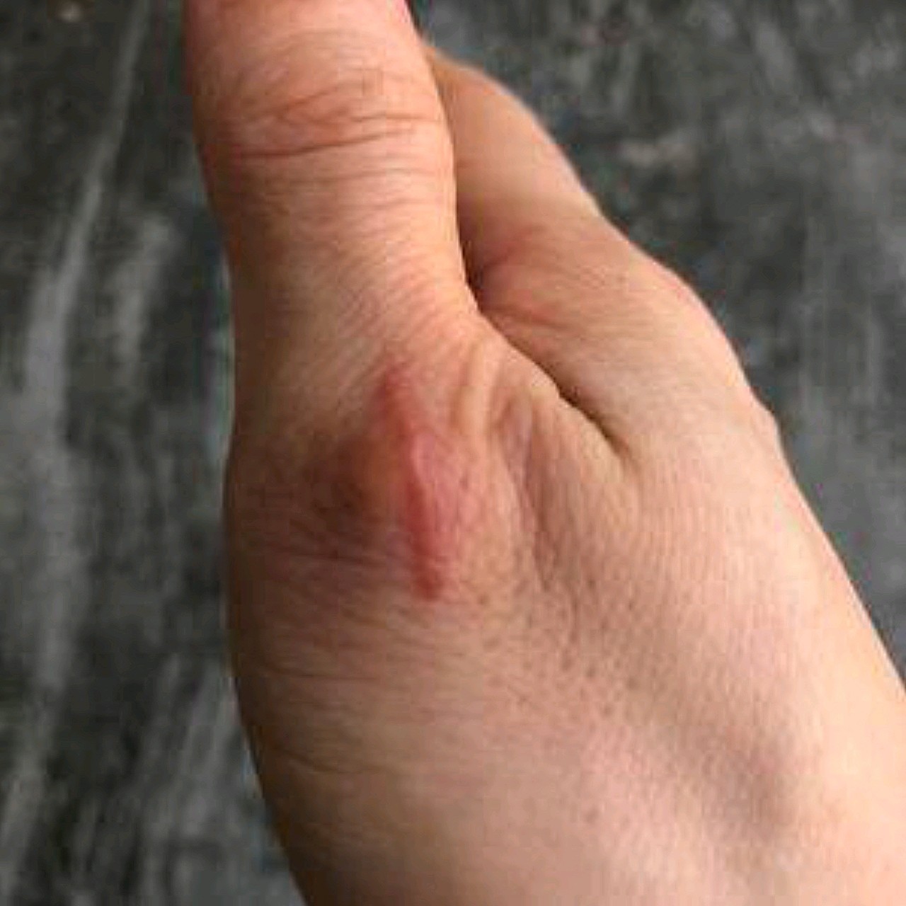 我手上的疤痕虽然不大,但是看着有点吓人,试过很多祛_圈子-新氧美容