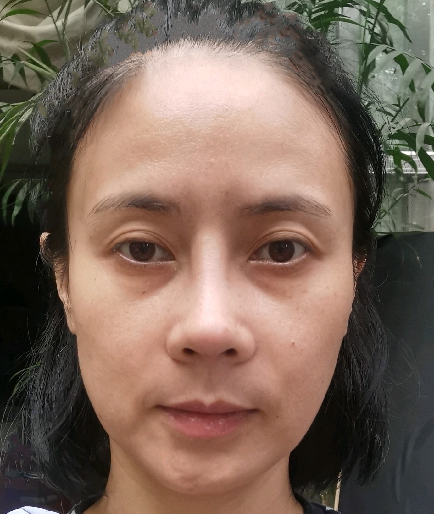 做了肋骨立秀膨体鼻部多项鼻基底今天第20天山根处发白不自然假体感很