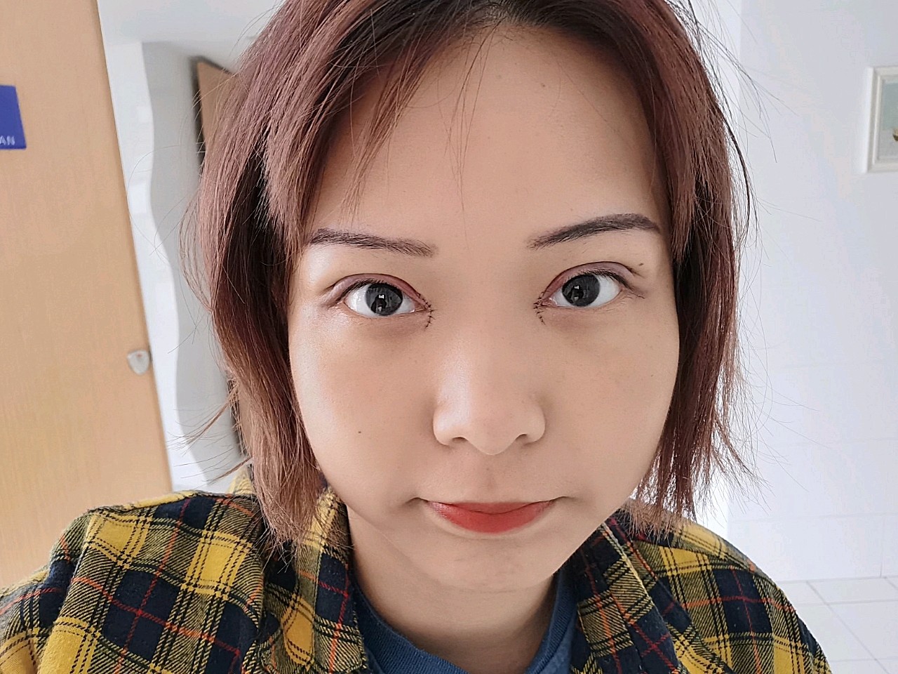 做双眼皮 开眼角的第一天,纪念一下
