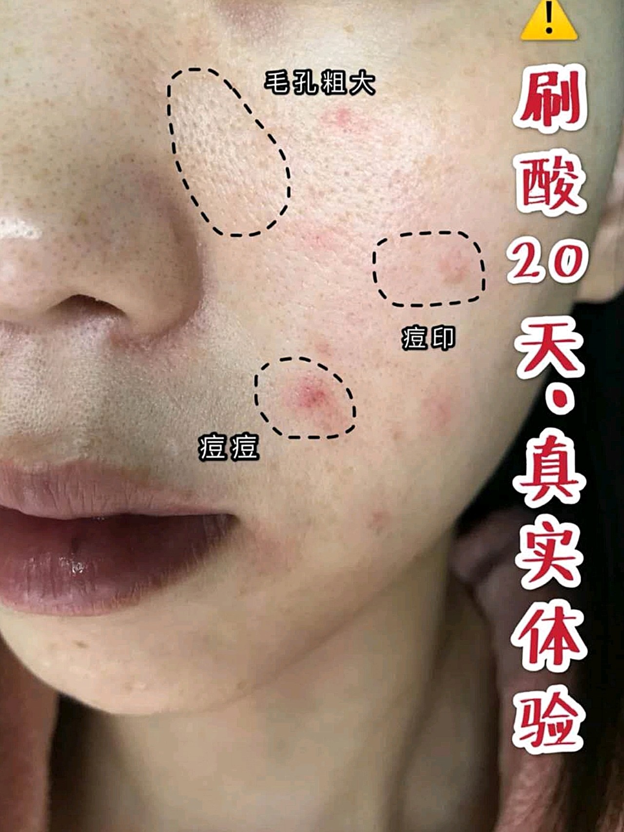 刷酸20天好像换了张脸附皮肤变化对比图