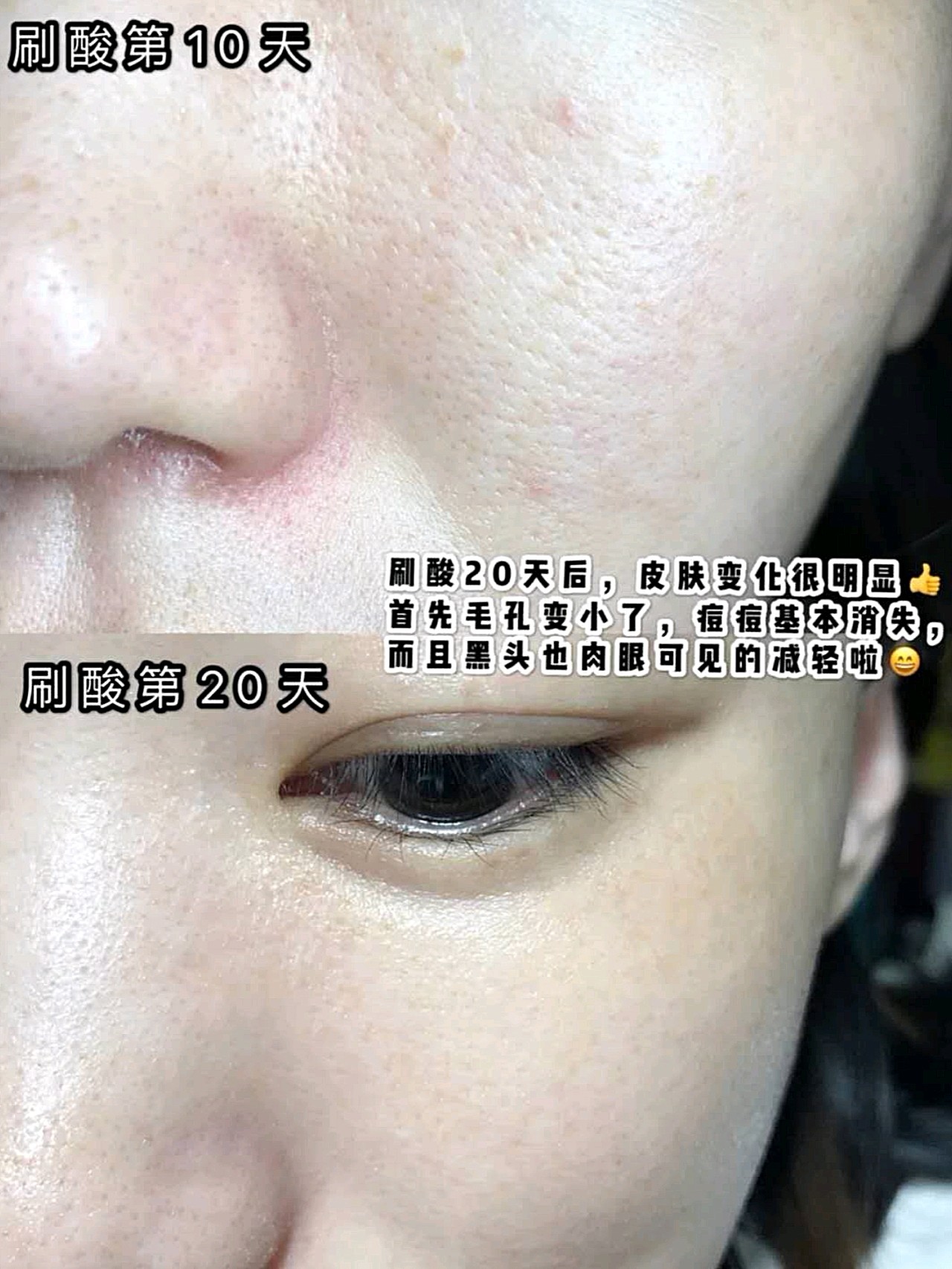 刷酸20天好像换了张脸附皮肤变化对比图