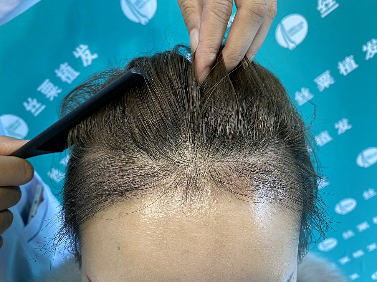 [:63][:63]到今天已经三个多月了,额角的头_圈子-新氧美容整形