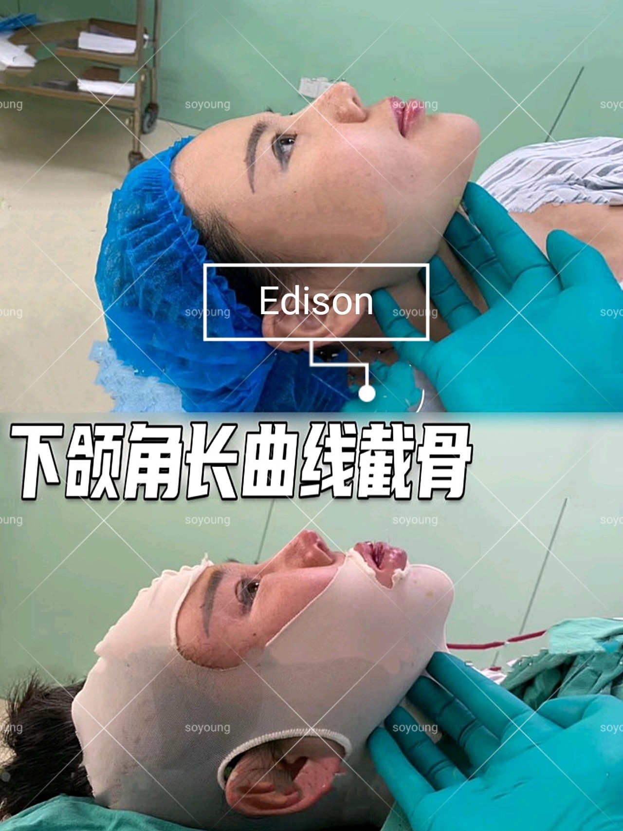 长曲线下颌角缩小术后即刻对比