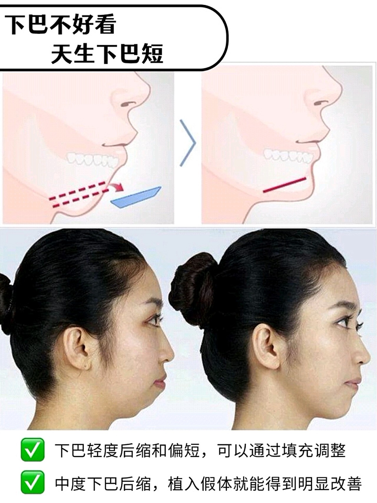 下巴后缩让神颜变河豚怎样的下巴最美