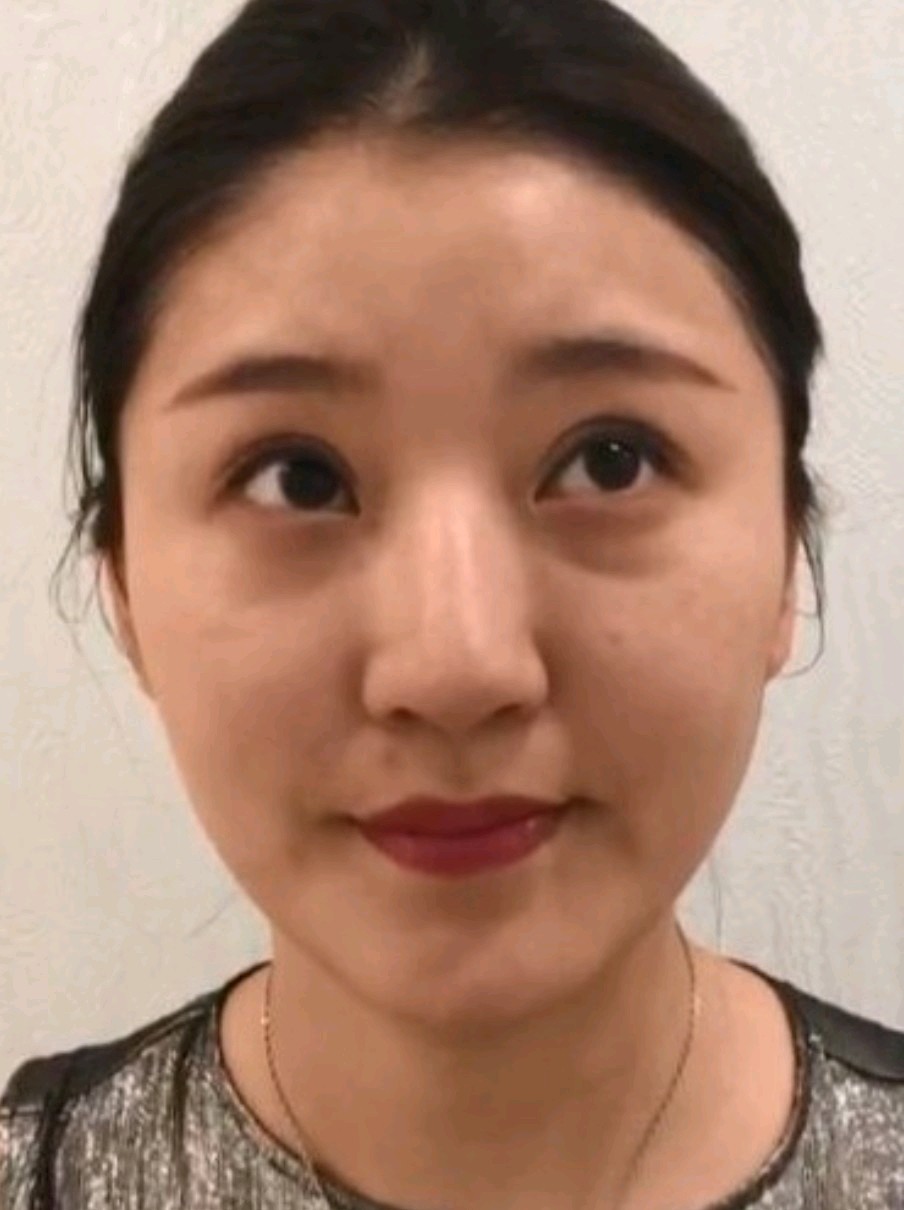 天生眼袋重,青春还没有绽放就先蔫儿了