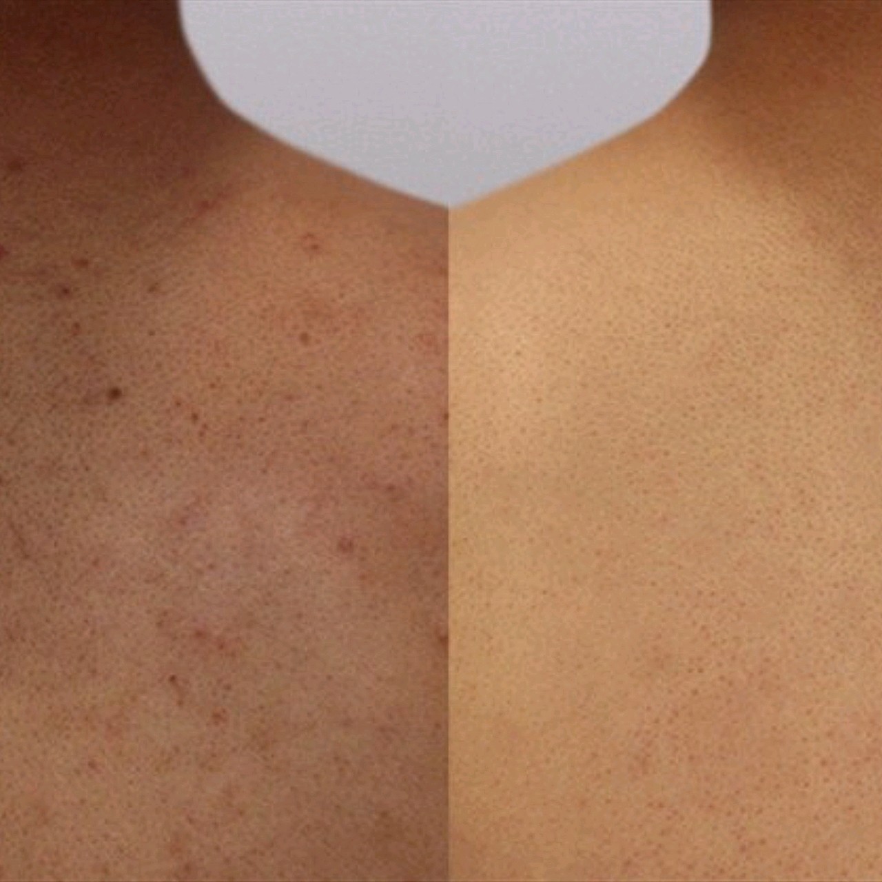 后背皮肤毛孔有小鸡皮疙瘩(后背皮肤毛孔有小鸡皮疙瘩怎么办)