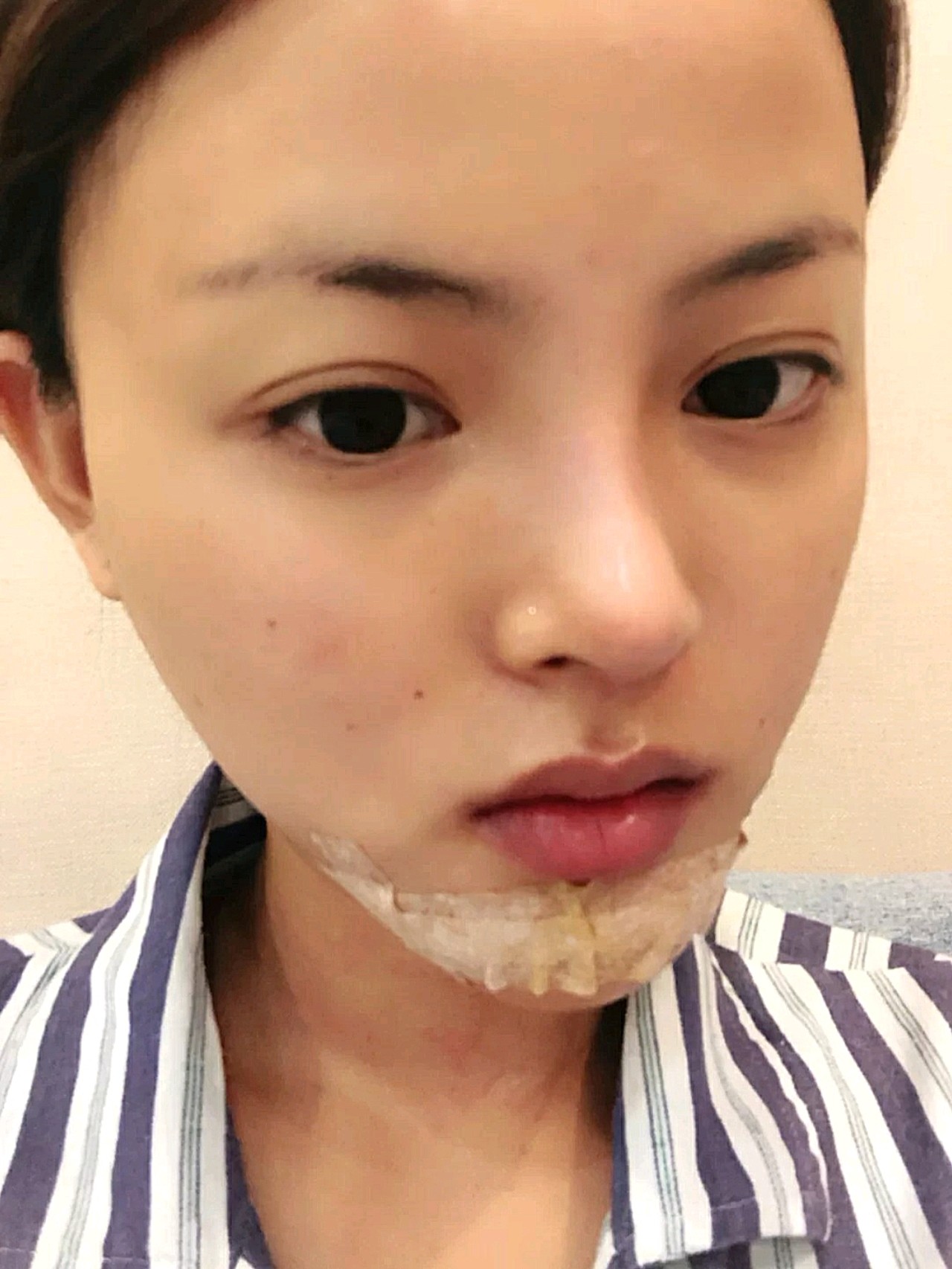 08今天是做了下巴两个个月整,和大家分享一下做下巴的_圈子-新氧