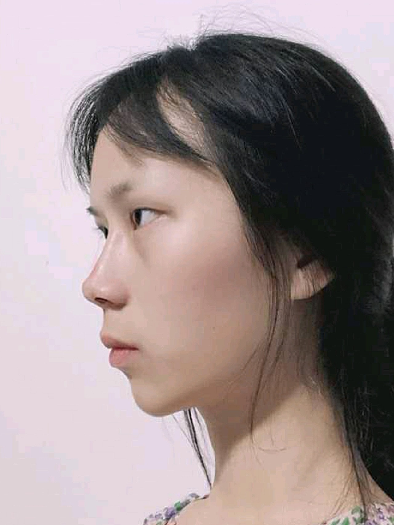 /韩缘聚美—肋骨盒鼻/就目前来看,我觉得高度是我喜_圈子-新氧美容整