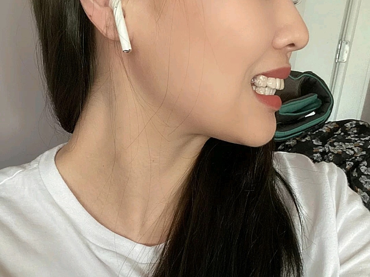 隐适美矫正小时候有做过传统的钢牙矫正,后来没有好_圈子-新氧美容