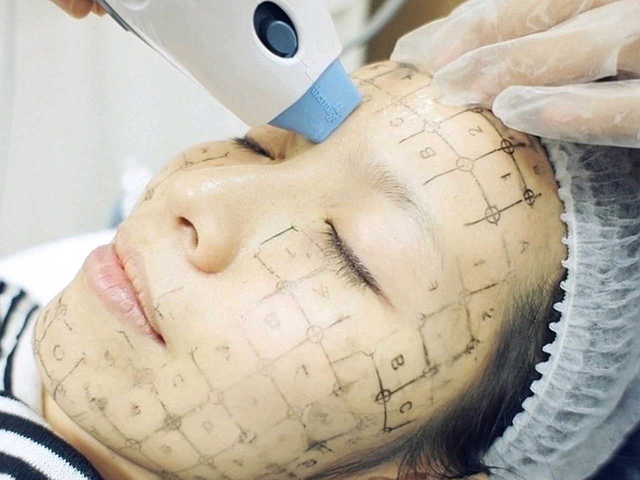 新一代热玛吉的体验分享