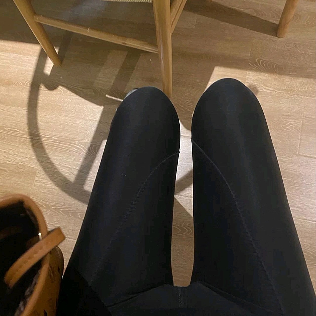 【沈阳汇美人大腿吸脂术后第22天】